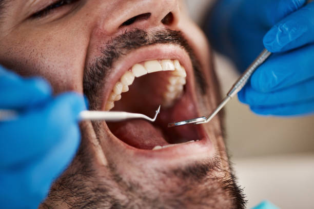 Best Emergency Treatment for Dental Infections or Abscesses in East San Gabriel, CA