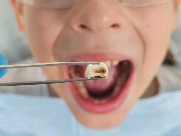 Best Urgent Care for Lost Fillings or Crowns in East San Gabriel, CA